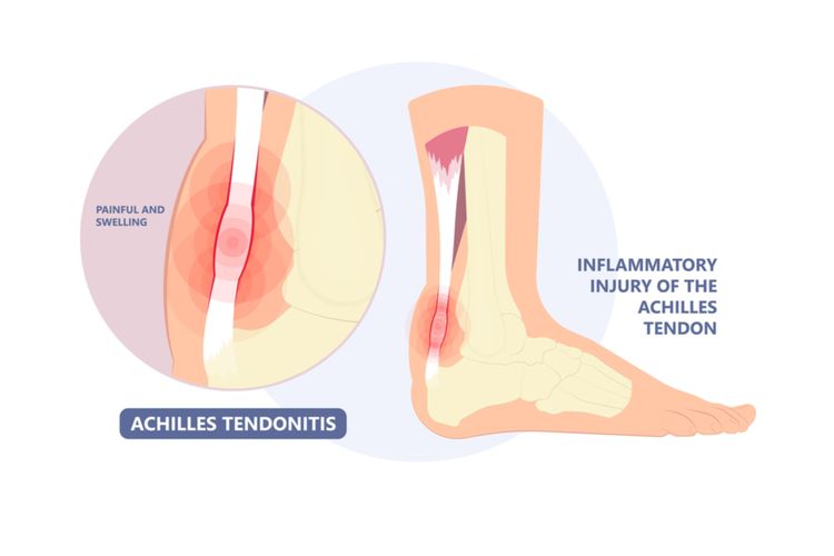 ilustrasi cedera tendon achilles