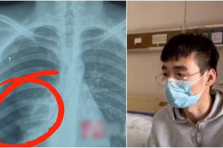 Hasil rontgen Wang Zhe menunjukkan bahwa ia menderita pneumotoraks, kondisi yang berpotensi mengancam jiwa, di mana gelembung udara terbentuk antara paru-paru dan dinding dada.
