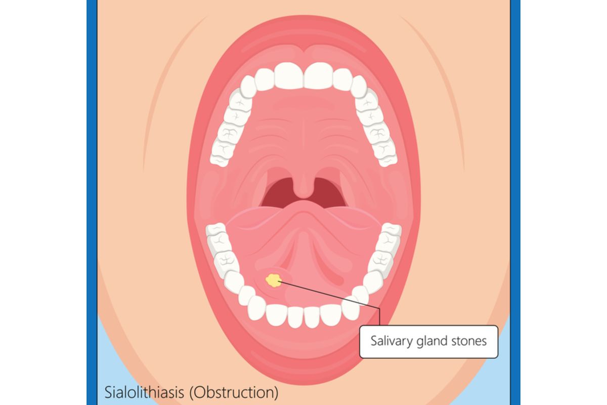 Ilustrasi batu kelenjar air liur