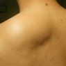 3 Cara Menghilangkan Lipoma, Tak Selalu Perlu Operasi