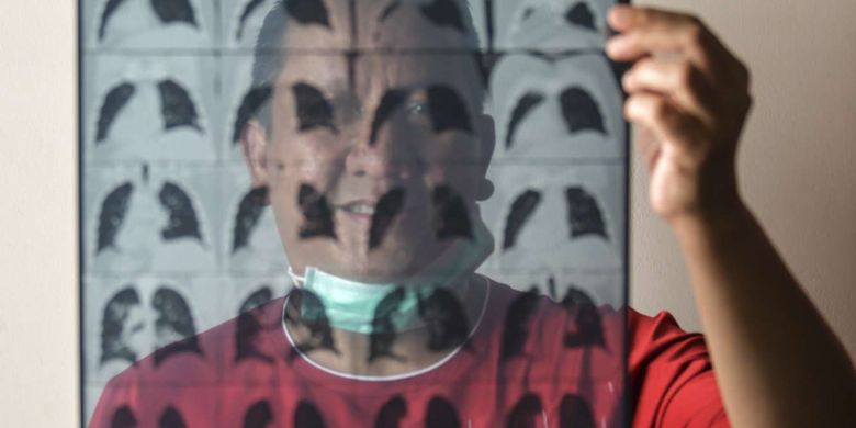 Simon Nainggolan (50) menunjukkan hasil rontgen paru-paru miliknya di Jakarta.