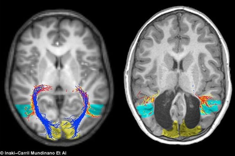 MRI kerusakan korteks visual