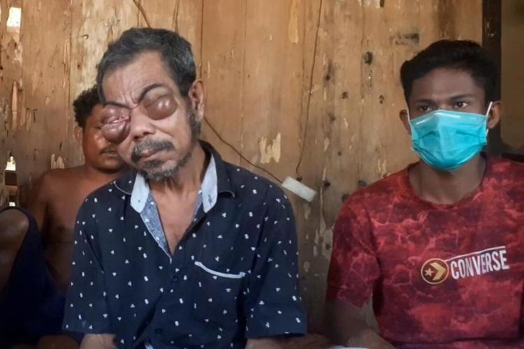 La Mauria (72) seorang petani asal Dusun Ulusadar, Desa Waesala, Kabupaten Seram Bagian Barat, Maluku hanya bisa pasrah dan berdoa agar pembengkakan mata yang membuatnya buta segera sembuh,