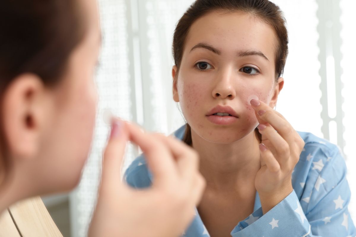 Ilustrasi perempuan pakai acne patch, apakah acne patch aman buat menyembuhkan jerawat?