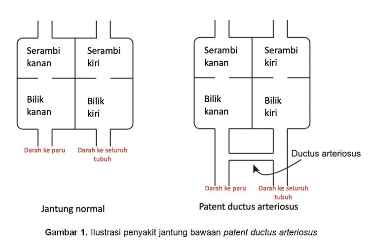 Ilustrasi penyakit jantung bawaan patent ductus arteriosus