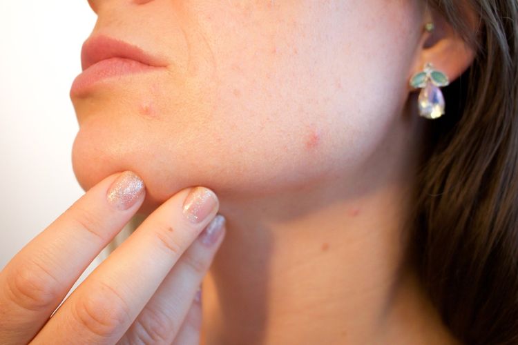 Salah satu manfaat madu untuk wajah adalah membantu mengobati luka dan menyamarkan bekas luka.