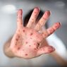 Cara Mengobati Gatal Gejala Flu Singapura, Jangan Sembarangan Digaruk