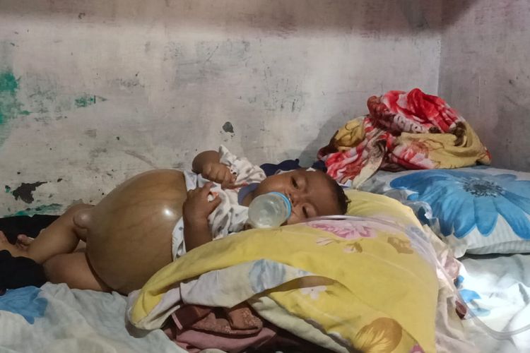 Seorang bayi penderita Atresia bilier di Medan, Sumatera Utara membutuhkan bantuan.