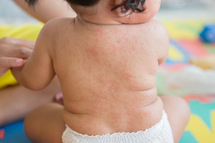 Ilustrasi Roseola Infantum