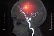 Kenali Apa Itu Aneurisma Otak, Penyebab, dan Tanda-tandanya