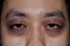 Mengenal Raccoon Eye, Kondisi Memar di Sekitar Kedua Mata