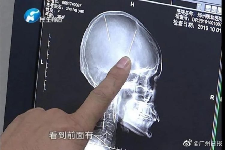 Citra dari pemindaian CT menunjukkan tengkorak seorang wanita bermarga Zhou di China. Tampilan itu menjadi sorotan karena diketahui, ada dua jarum yang menancap di otak Zhu.