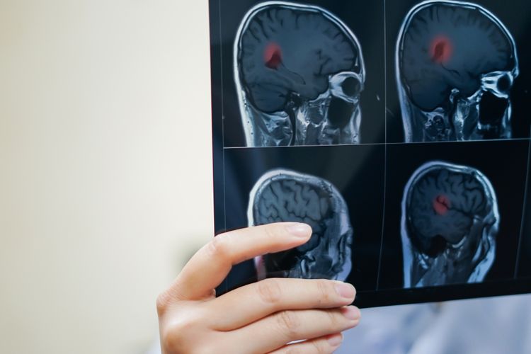 Mengenal Jenis Jenis Tumor Otak Konsultasi Kesehatan