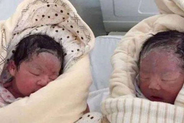 Perempuan di China Kaget Rasakan Gerakan di Perut Usai Lahirkan Bayi Kembar, Ternyata Ini yang Terjadi