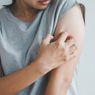 4 Cara Mengobati Scabies dengan Bahan Alami