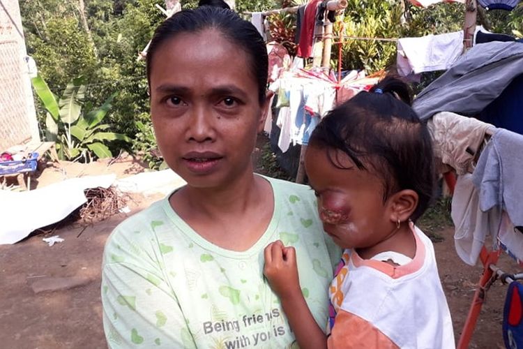 Dela Puspita (4) warga Desa Petir, Kecamatan Dramaga, Bogor, Jawa Barat, menderita penyakit tumor ganas sejak usia 3 tahun.
Bocah berusia empat tahun ini merasakan kesakitan yang amat luar biasa akibat tumor yang kian membesar.