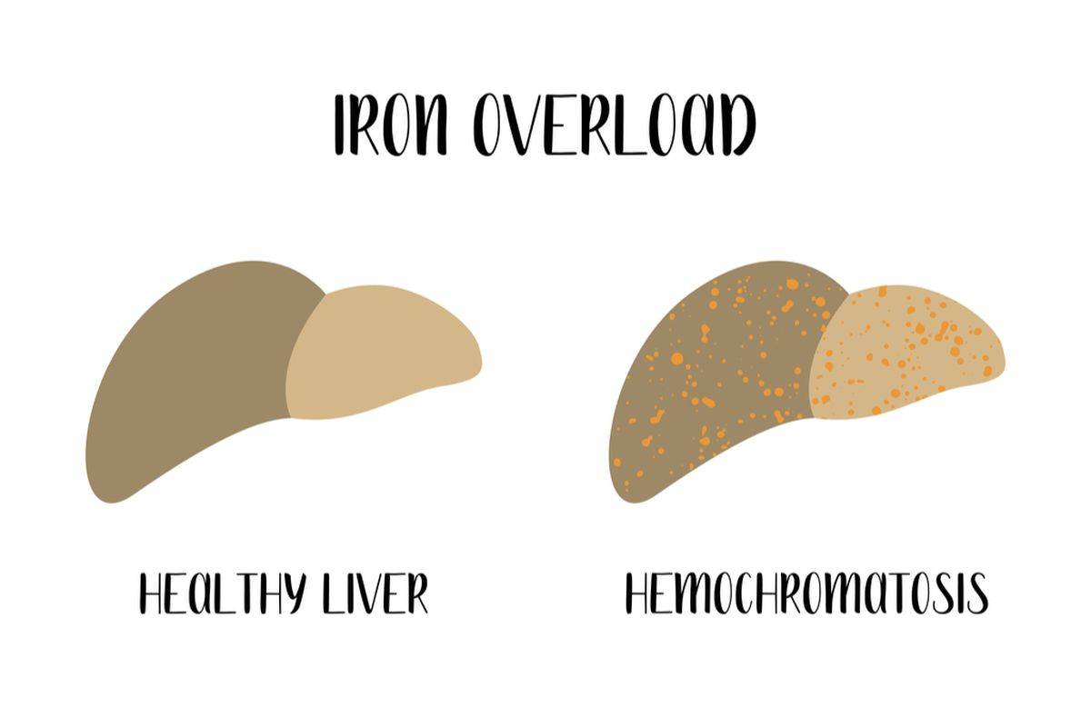 Ilustrasi hemokromatosis