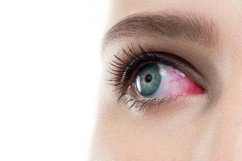4 Penyebab Mata Merah, Salah Satunya Alergi