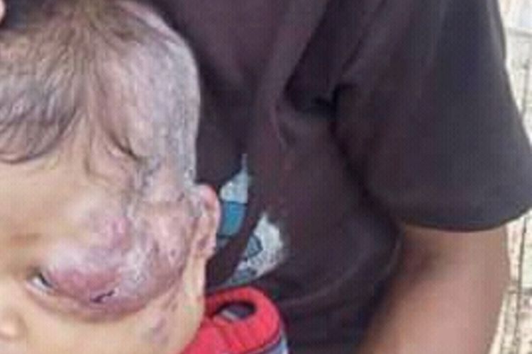 Seorang bayi, 10 bulan di Kampung Wera, Desa Golo Tolang, Kecamatan Kota Komba, Manggarai Timur, NTT, Minggu, (12/7/2020) mengalami tumor di pelipis kirinya hingga benjolan besar menutup sebagian mata kirinya, telinga dan kepalanya. (KOMPAS.com/MARKUS MAKUR)