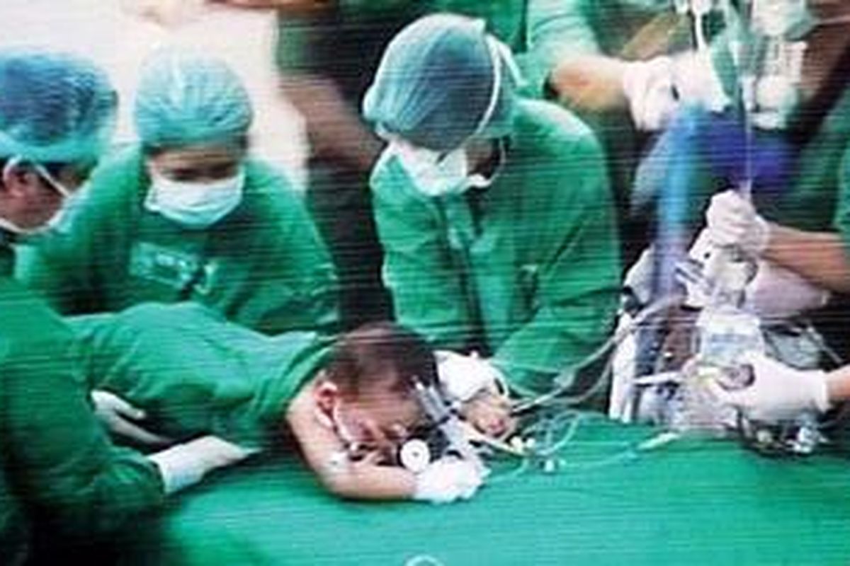 Suasana ruang operasi setelah Rochim dipisahkan dari kembarnya, Rochman, yang diambil melalui layar televisi di RSU Dr Soetomo, Kota Surabaya, Jawa Timur, Sabtu (9/4/2011) malam. Kedua bayi berusia 19 bulan tersebut dempet di bagian pinggul dan hanya memiliki satu alat kelamin.