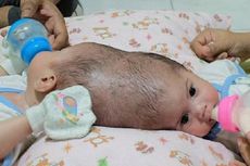Bayi Kembar di Tanjung Pinang Lahir dengan Kepala Menyatu