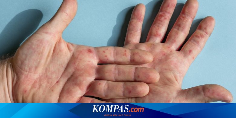 Penyakit Berbeda tapi Mirip, Gejala Flu Singapura dan DBD Sering Disamakan