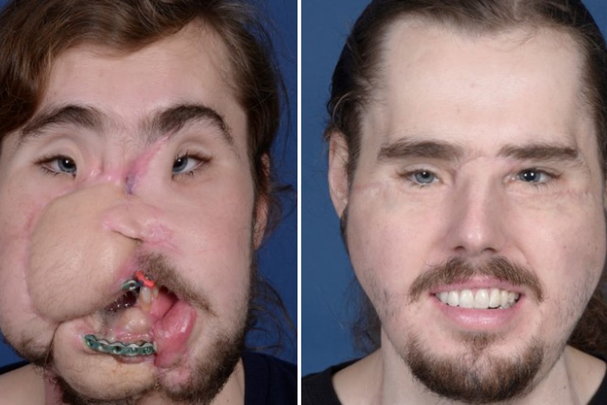 Cameron Underwood sebelum melakukan operasi transplantasi wajah dan 11 bulan setelah menjalani operasi.