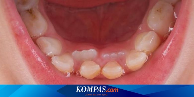 Kenali, Makanan yang Merusak Gigi Anak - Vimarsana News