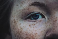 Kenapa Ada Orang Punya Bintik Freckle di Wajah?
