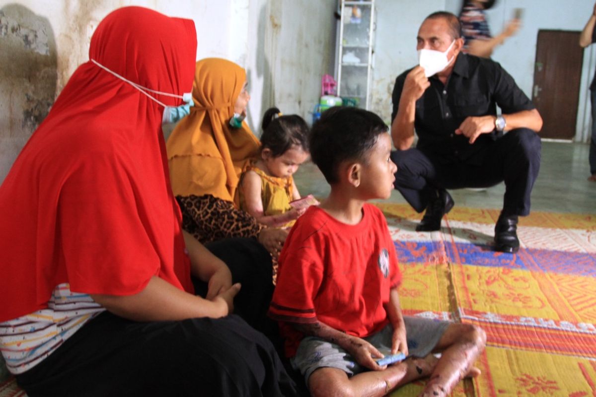 Gubernur Sumut, Edy Rahmayadi menjenguk Haikal dan Zakira, dua bocah penderita penyakit kulit aneh di Medan, Minggu (4/7/2021).