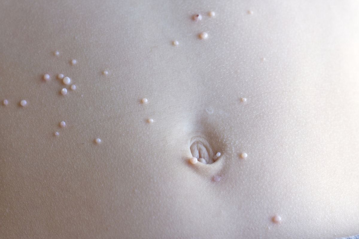 Ilustrasi Molluscum Contagiosum