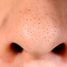 Apa Penyebab Komedo di Hidung?