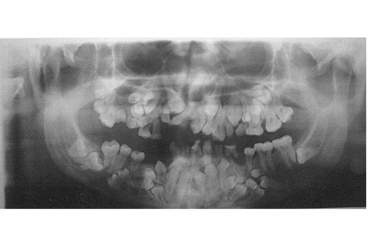 Gambaran radiografi hiperdonsia, kelainan gigi pada anak yang memiliki hampir 50 gigi