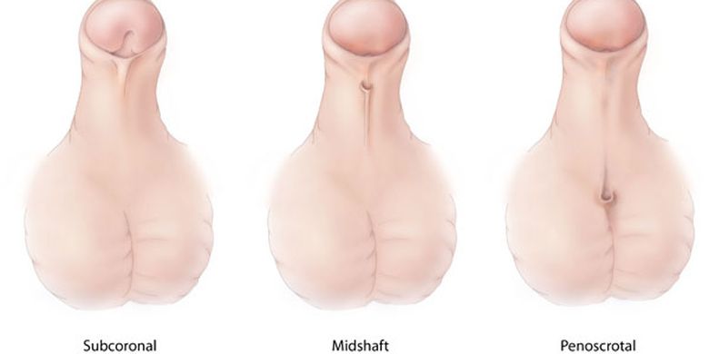 Hipospadia adalah kondisi bawaan lahir di mana pembukaan uretra (saluran kemih) tidak normal. Ada tiga jenis hipospadia berdasarkan pembukaan uretra.