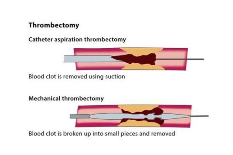 Ilustrasi prosedur trombektomi. 