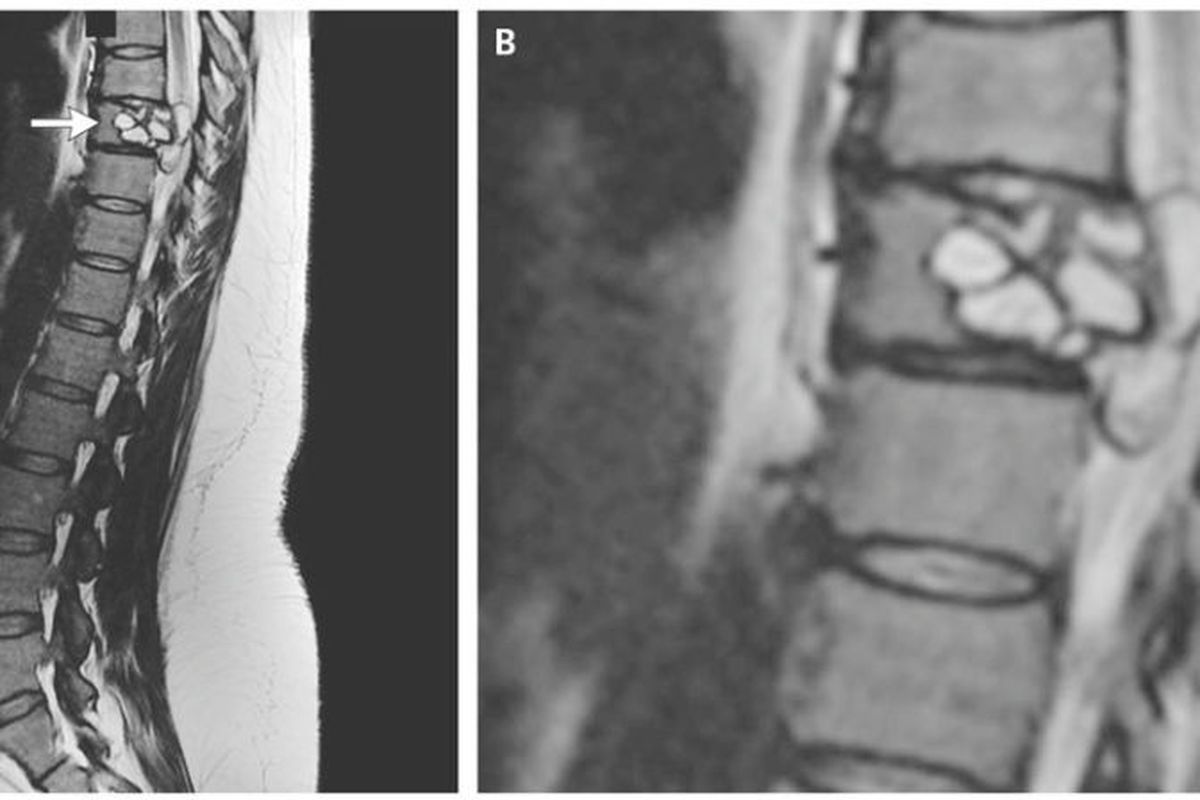 Hasil pemindaian MRI menunjukkan ada lesi berisi cacing pita di tulang belakang seorang perempuan 35 tahun asal Perancis yang membuat kakinya mati rasa dan kehilangan keseimbangan.