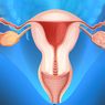 Apa yang Menyebabkan Terjadinya Kanker Ovarium?