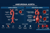 Bahaya Gangguan Aorta yang Kerap Tak Bergejala dan Cara Mencegahnya