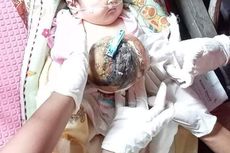 Mari Bantu M Fareski, Bayi di Riau yang Menderita Omphalocele