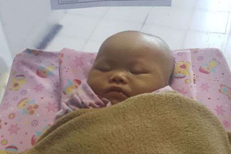 Rosmalia Nurhalizah, bayi yang baru berusia 16 hari yang terlahir tanpa lubang anus (Atresia Ani).