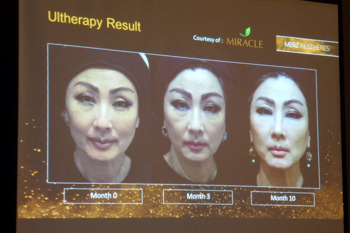 Contoh hasil perawatan Ultherapy salah satu pasien Miracle Aesthetic.