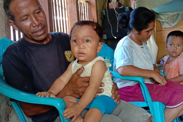Foto : Arnoldus Dehan Jangku, bayi 10 bulan asal Desa Persiapan Ulungali I, Kecamatan Satarmese, Kabupaten Manggarai, NTT, menderita tumor di hidung.