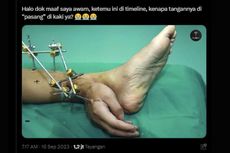 Ramai soal Foto Tangan Disambung ke Kaki Ketika Operasi, Ini Kata Dokter