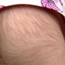 Dikira Minum Obat Sakit Perut, 20 Anak Tumbuh Bulu di Tubuh Mereka