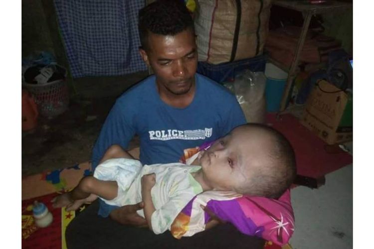 Seorang relawan Selamatkan Hofni, Mika Ganobal sedang menggendong bayi Hofni yang menderita penyakit Hidrosefalus di rumah bayi malang itu di Kelurahan Siwalima,  Dobo,  Kabupaten Kepulauan Aru, Maluku.
