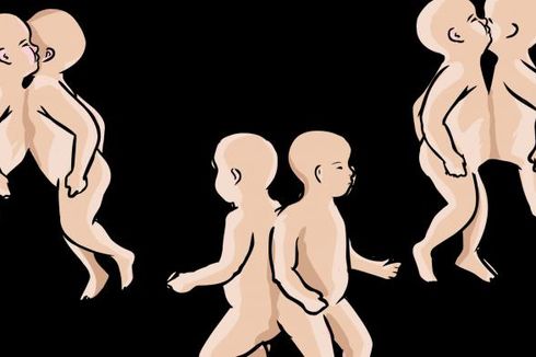 Dirawat 10 Hari, Bayi Kembar Siam Asal Padalarang Meninggal Dunia