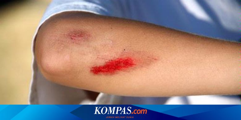 Pertolongan Pertama Atasi Pendarahan