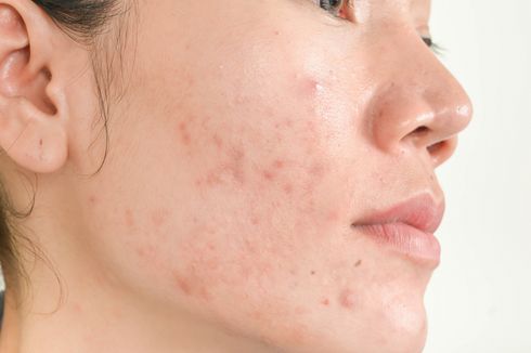 8 Perawatan Lawan Jerawat Ini Dilarang Ahli Dermatologi