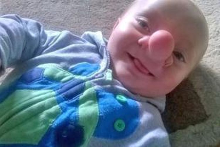 Ollie, bayi yang dijuluki pinokio karena pertumbuhan otak di hidungnya.