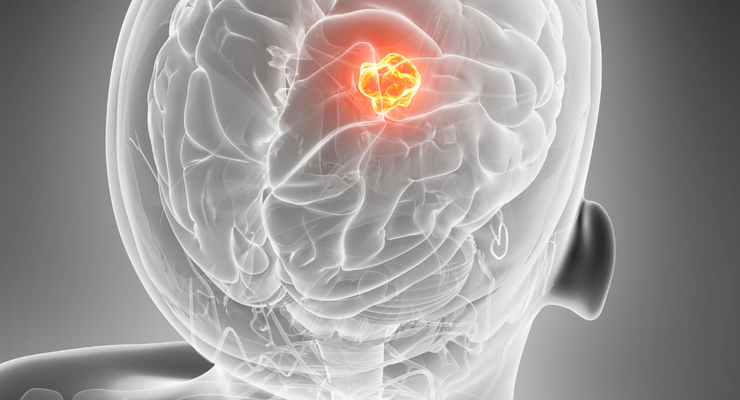 Studi: Diet Khusus Bisa Bantu Perawatan Kanker Otak Glioblastoma